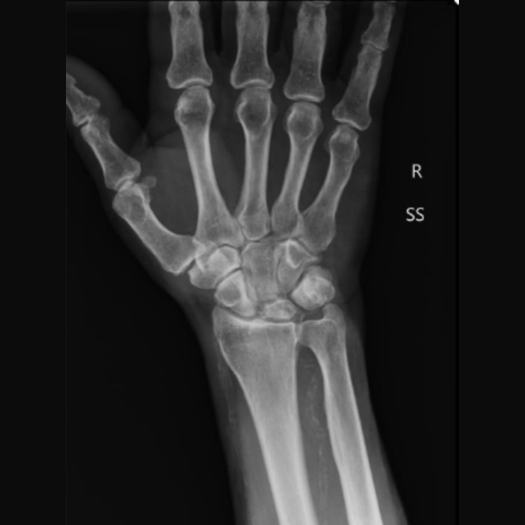 Болезнь Кинбека: сохранить подвижность запястья и вернуться к жизни без боли