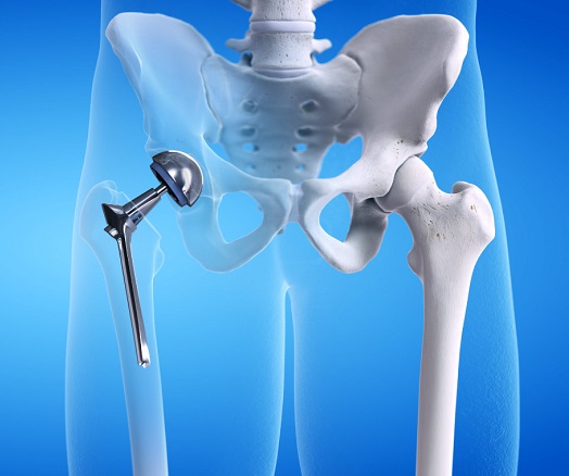 Эндопротезирование тазобедренного сустава: возвращение к активной жизни