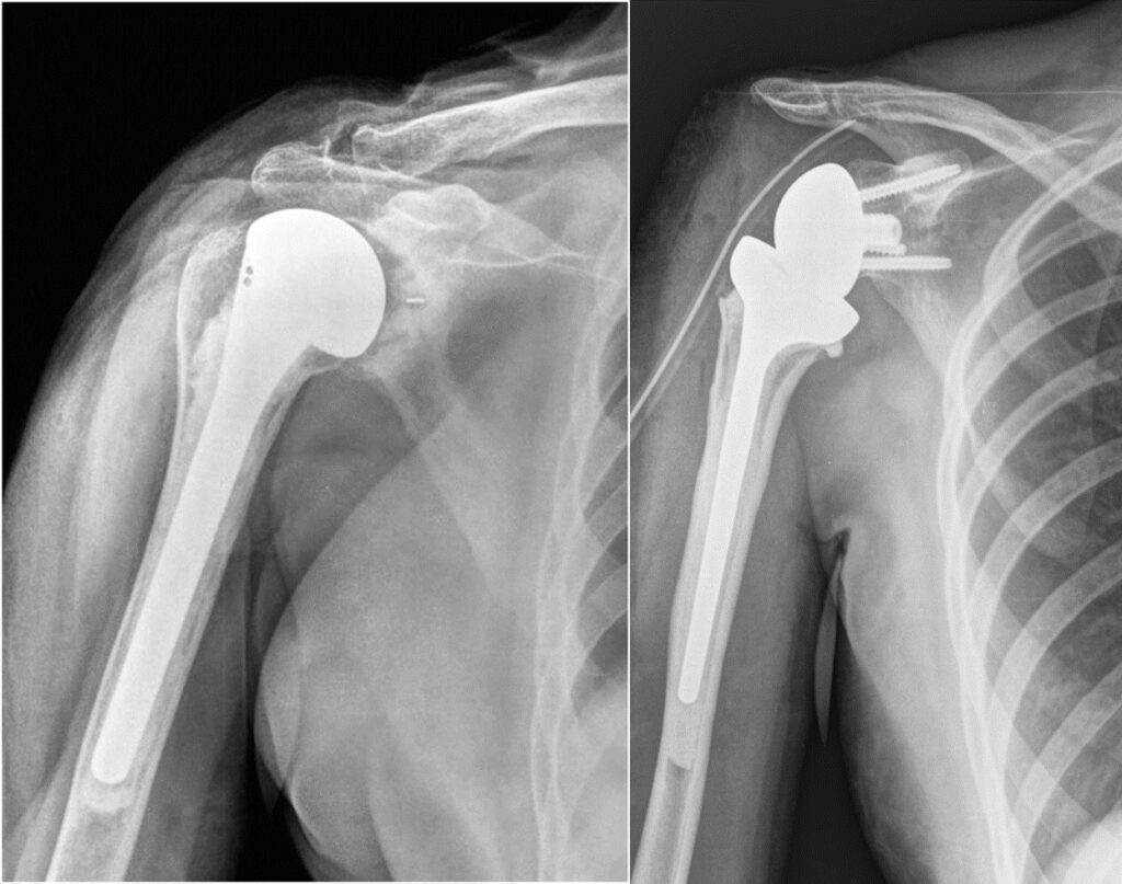 Эндопротезирование плечевого сустава для возвращения к активной жизни