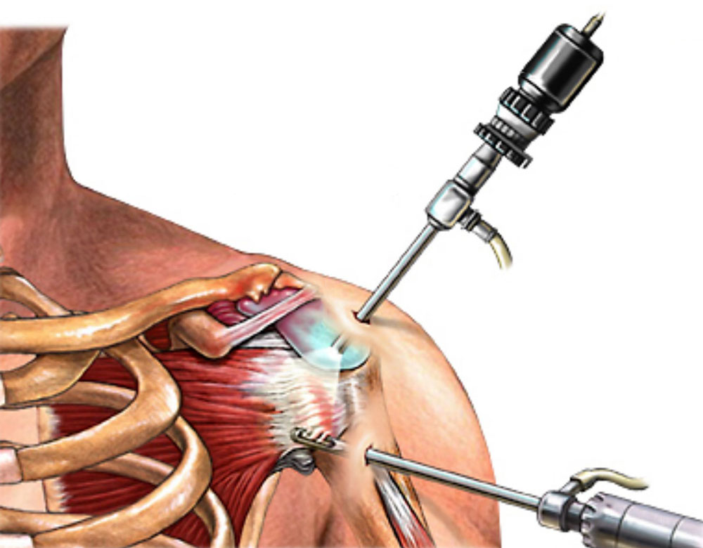 Артроскопия плечевого сустава: полное руководство по операции и восстановлению