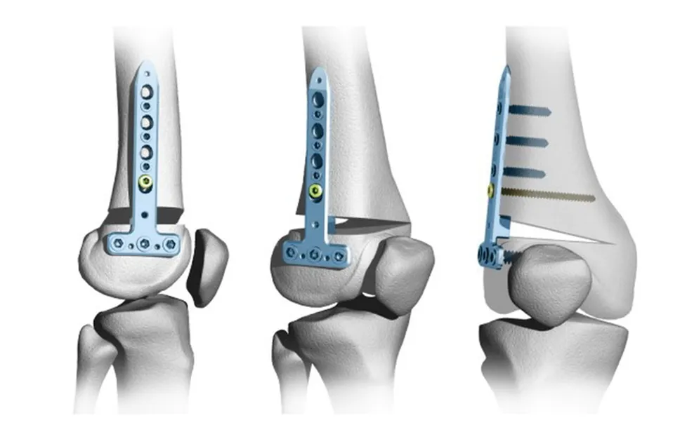 Корригирующая остеотомия как способ сохранить сустав и отсрочить протезирование