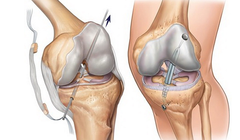 Реконструкция передней крестообразной связки: возвращение к активной жизни