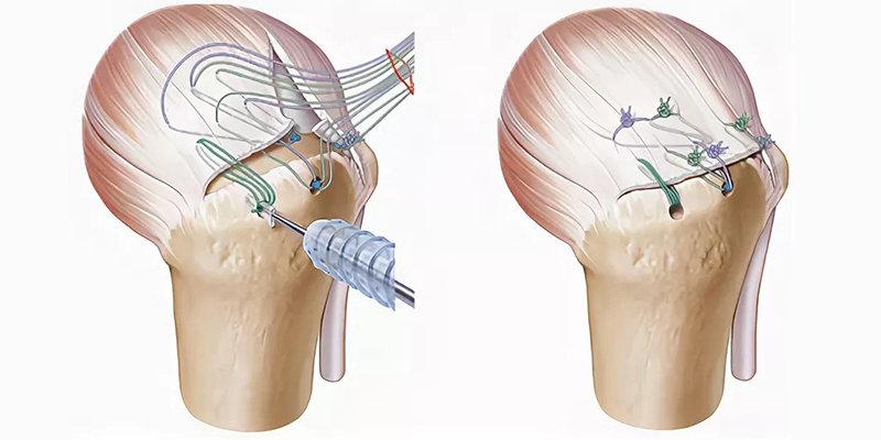 Восстановление вращательной манжеты плеча: полное руководство по операции