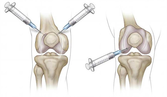 Внутрисуставные инъекции для лечения артроза и восстановления подвижности