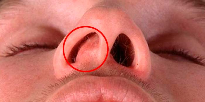 Фурункул носа: полное руководство по безопасному лечению и профилактике