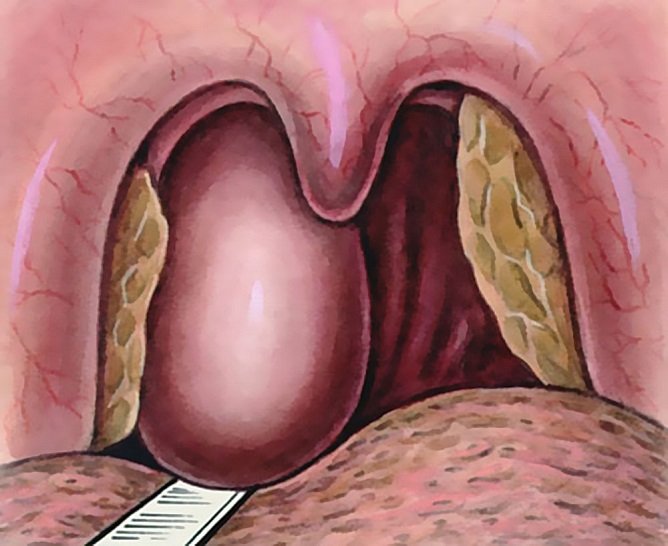 Заглоточный абсцесс: полное руководство по лечению и предотвращению осложнений