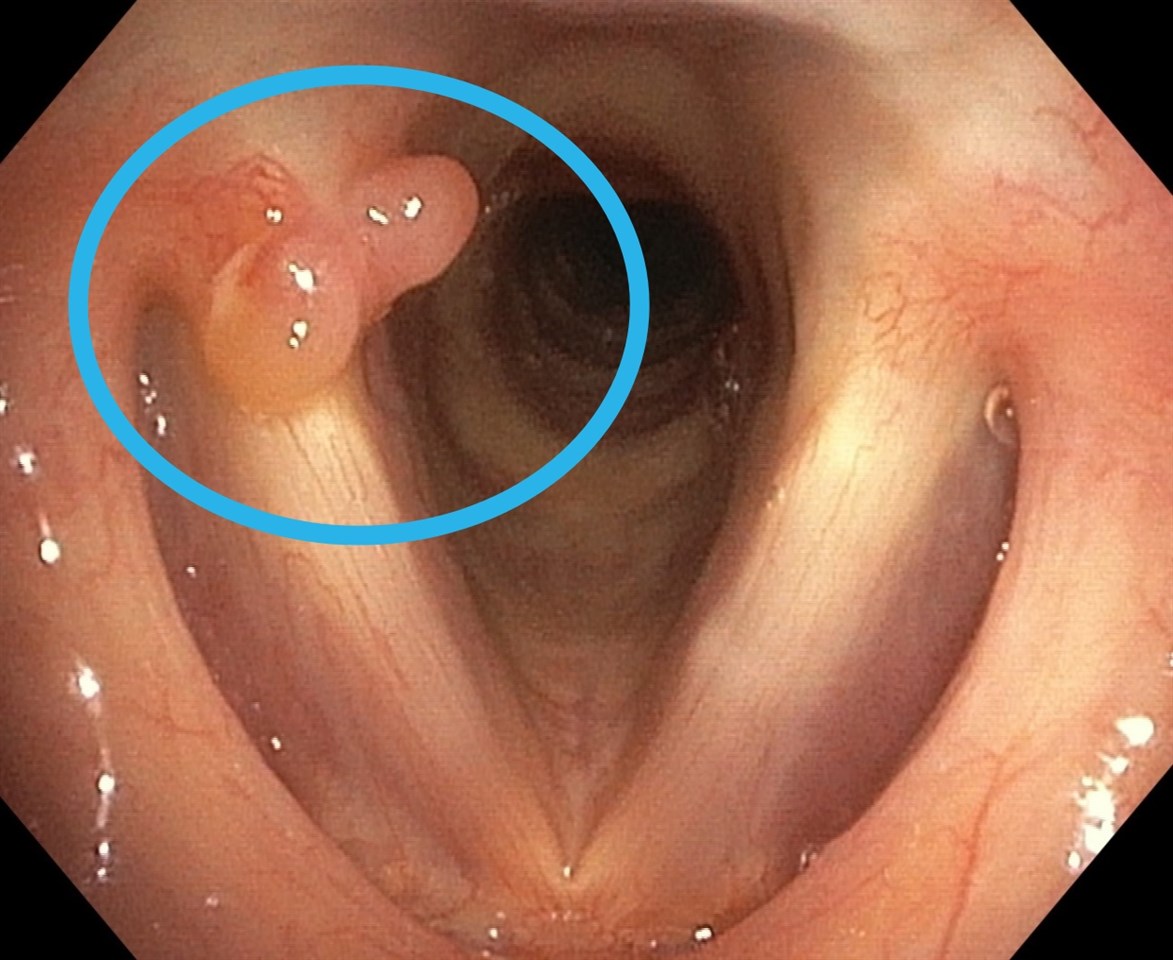 Восстановление чистоты голоса при полипах голосовых складок: ваш полный гид