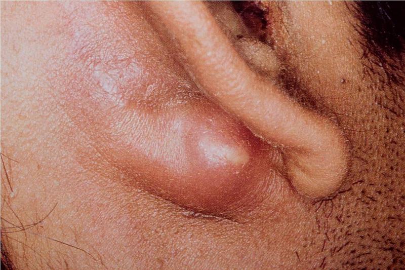 Мастоидит: как распознать и вылечить воспаление за ухом без осложнений