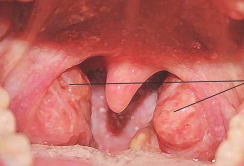 Аденотомия у взрослых: возвращаем свободное дыхание и здоровый сон