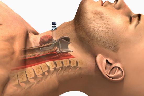 Трахеостомия: полное руководство по операции, уходу и жизни после нее