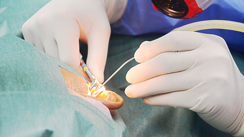 Мастоидэктомия: полное руководство по операции на сосцевидном отростке