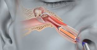 Катетеризация слуховой трубы для восстановления слуха и давления в ухе