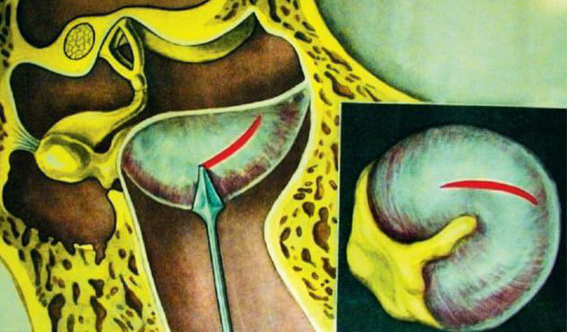 Парацентез барабанной перепонки: когда нужен прокол для лечения отита