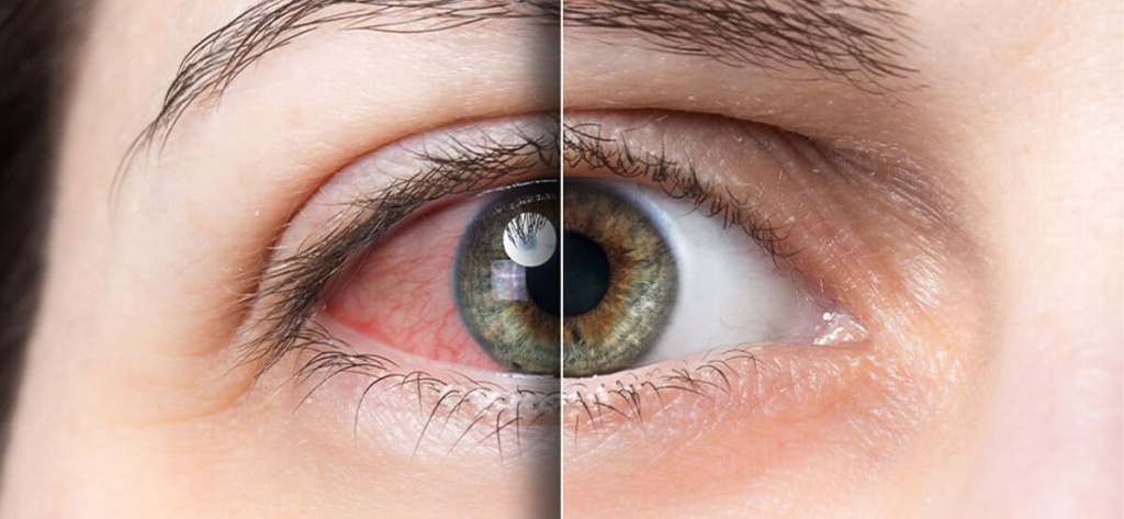 Синдром сухого глаза: полное руководство по причинам, симптомам, лечению