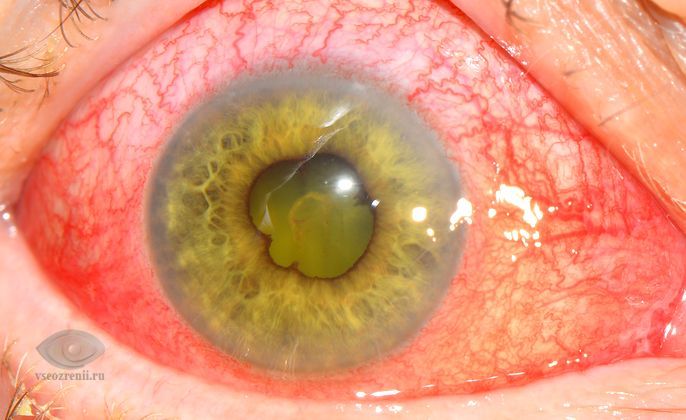 Иридоциклит: полное руководство по причинам, симптомам и эффективному лечению