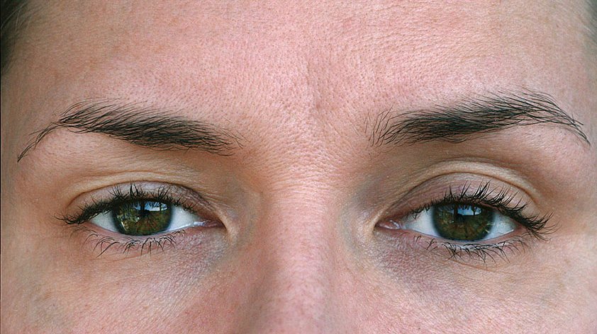 Птоз верхнего века: полное руководство по причинам, диагностике и лечению