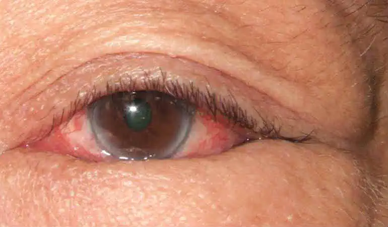 Энтропион века: полное руководство по причинам, симптомам и лечению