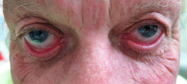 Эктропион века: подробное руководство по причинам и лечению