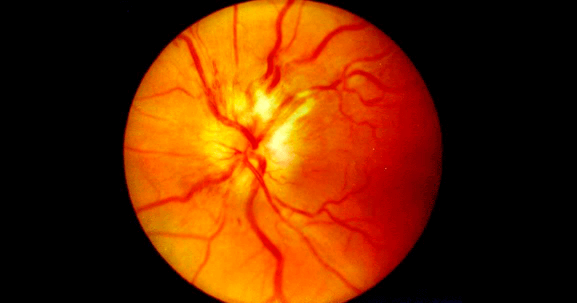 Неврит зрительного нерва: причины, симптомы, диагностика и эффективное лечение