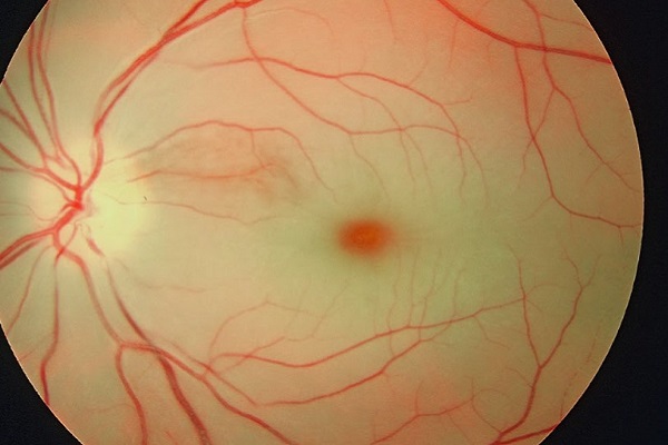 Окклюзия артерий сетчатки: полное руководство по причинам, симптомам и лечению