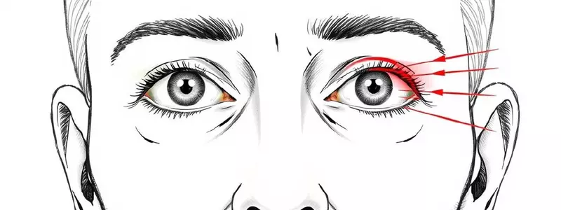 Нистагм: причины, виды, симптомы и современное лечение непроизвольных движений глаз
