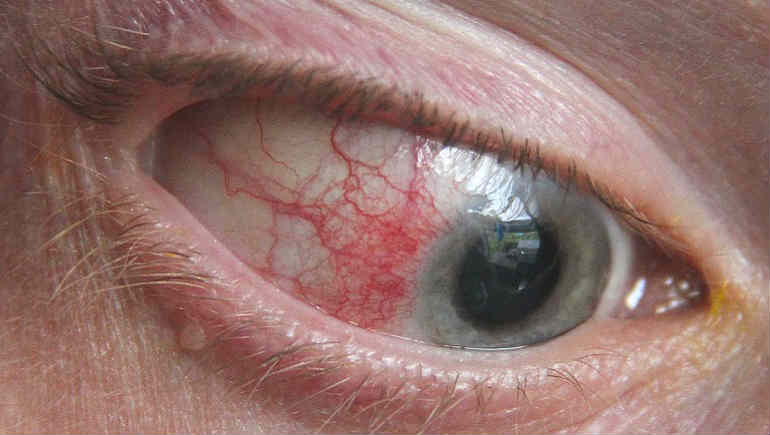 Эписклерит: причины, симптомы, диагностика и эффективное лечение воспаления глаза