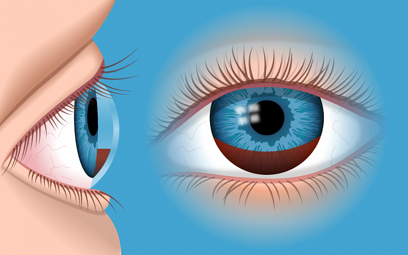 Гифема глаза: причины, симптомы, диагностика и эффективное лечение