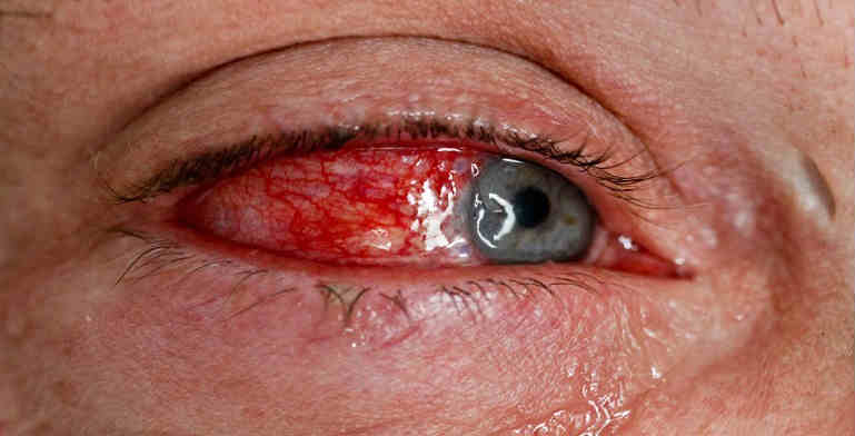 Ожог глаза: что делать при травме, причины, симптомы, лечение и прогноз