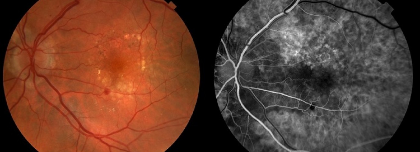 Флюоресцентная ангиография сетчатки: полное руководство по диагностике заболеваний глаза