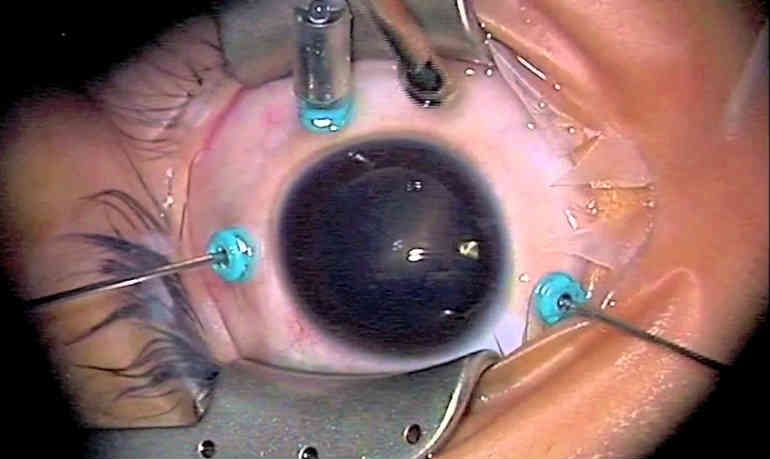 Витрэктомия глаза: полное руководство по операции и восстановлению зрения