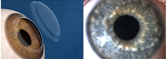 Кератопластика: полное руководство по пересадке роговицы и восстановлению