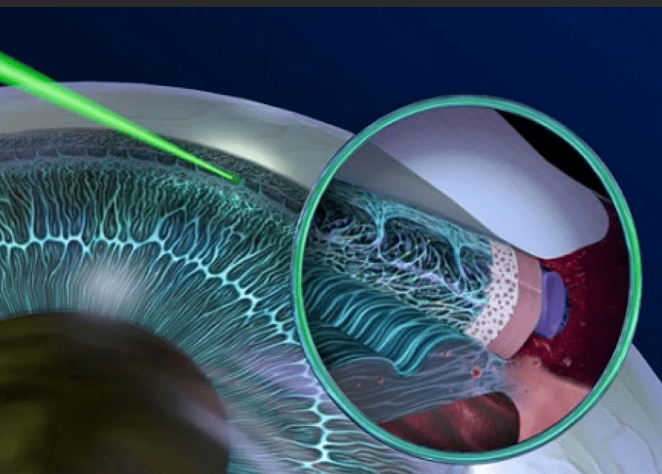 Трабекулэктомия глаза: все о хирургии глаукомы и реабилитации