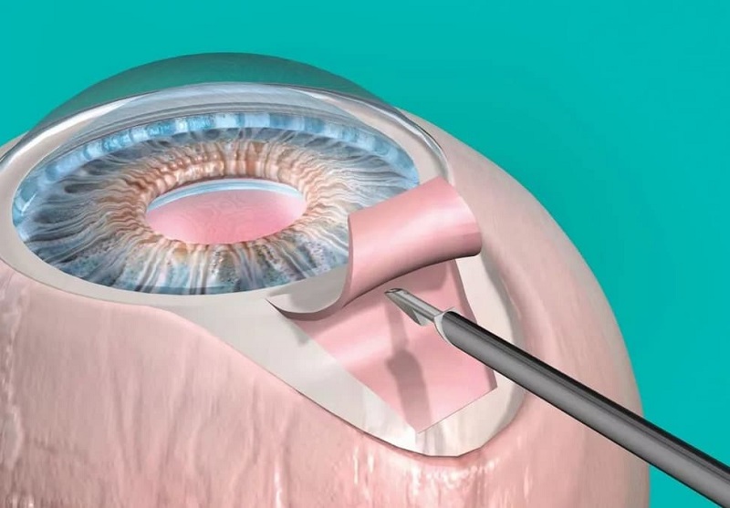 Лазерная иридэктомия: полное руководство по процедуре, показаниям и восстановлению