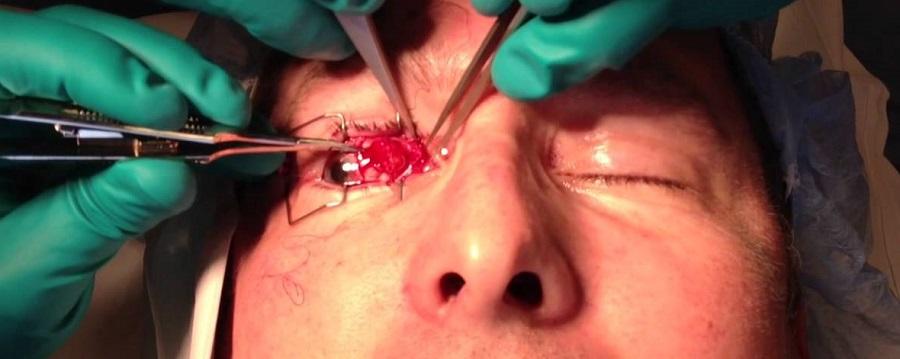 Хирургическое лечение косоглазия: показания, современные методы и этапы восстановления