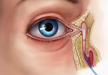 Дакриоцисториностомия: восстановление оттока слезы и избавление от дискомфорта