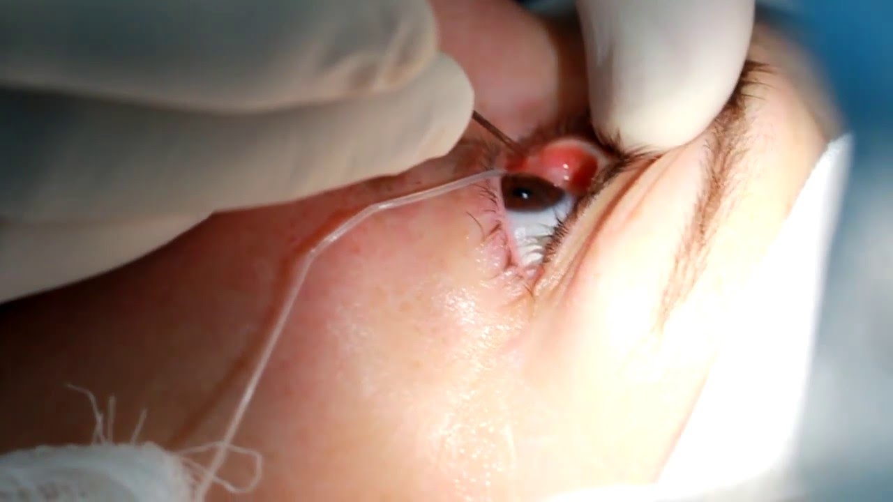 Зондирование слезно-носового канала: полное руководство по процедуре и восстановлению