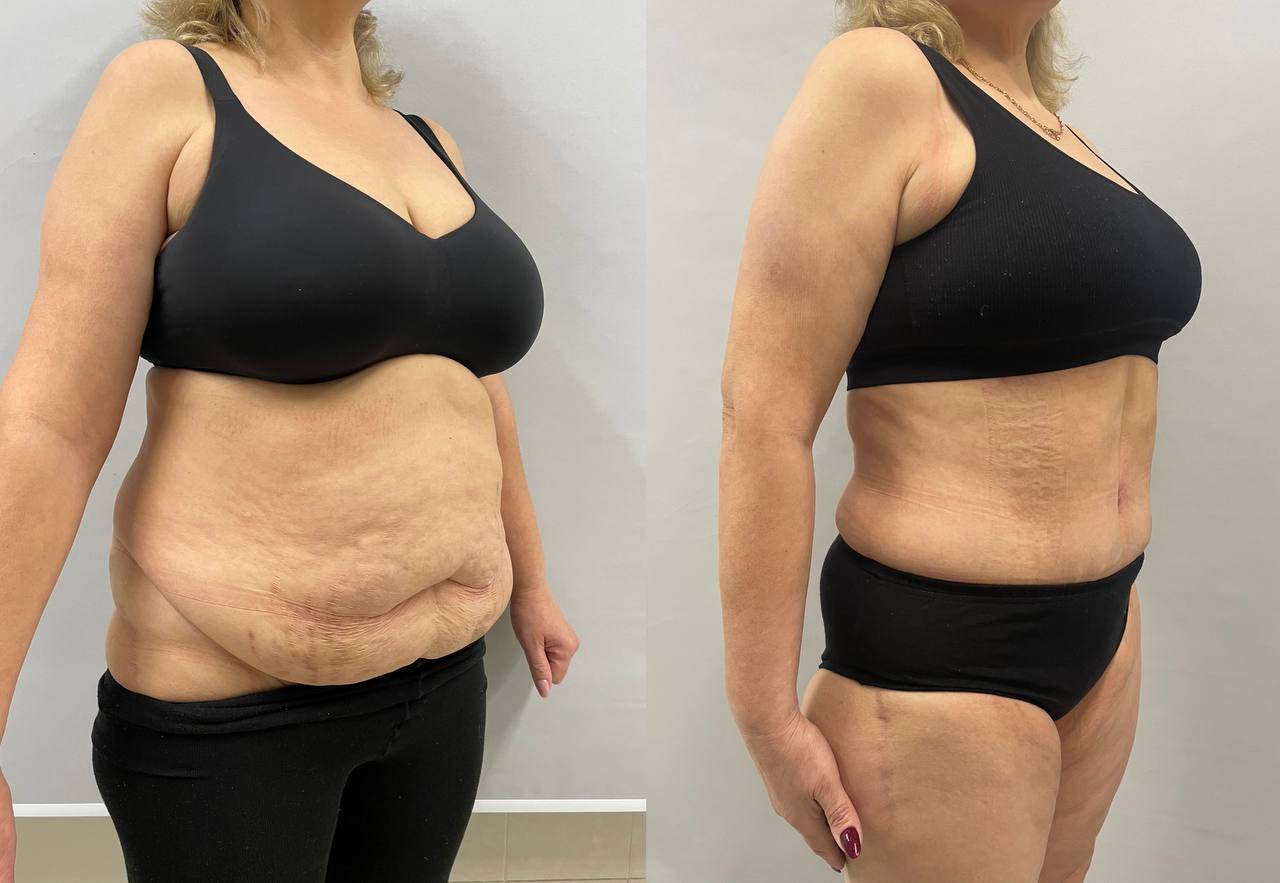 Липосакция: полное руководство по созданию идеальных контуров вашего тела