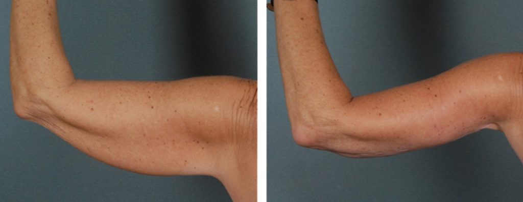 Брахиопластика для создания изящного контура рук: полное руководство