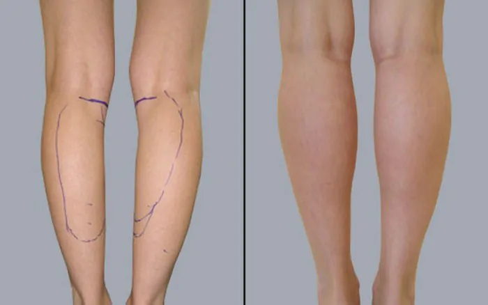 Круропластика для идеальной формы ног: полное руководство по пластике голеней