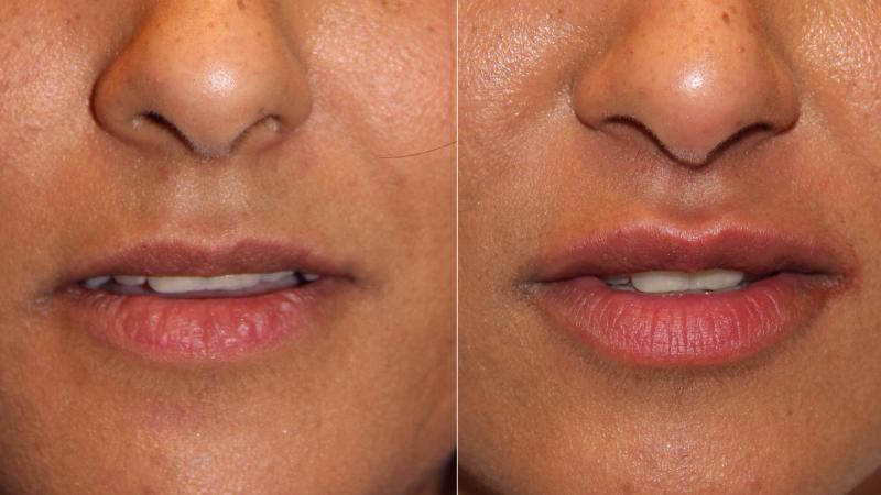 Хейлопластика для достижения идеальной формы и объема губ на долгие годы