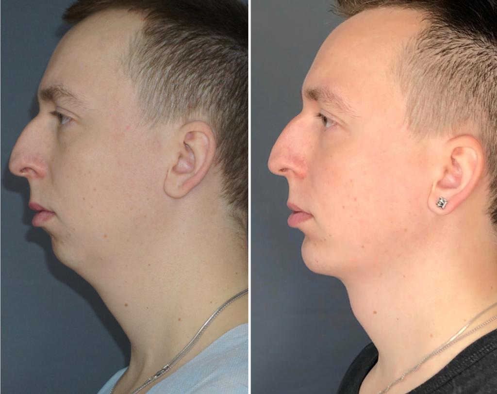 Гениопластика для гармоничного профиля: полное руководство по пластике подбородка