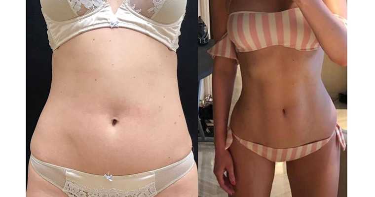 Липофилинг тела для создания идеальных контуров и объемов