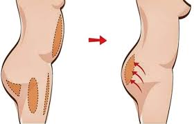 Липофилинг ягодиц для создания гармоничных и естественных контуров тела