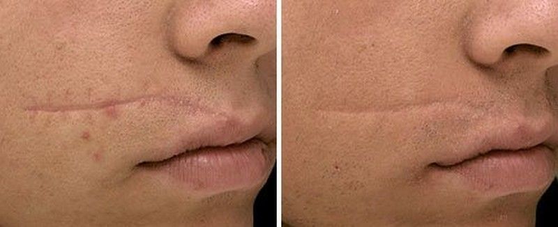 Коррекция рубцов и шрамов: обретение гладкой кожи с помощью новых методов