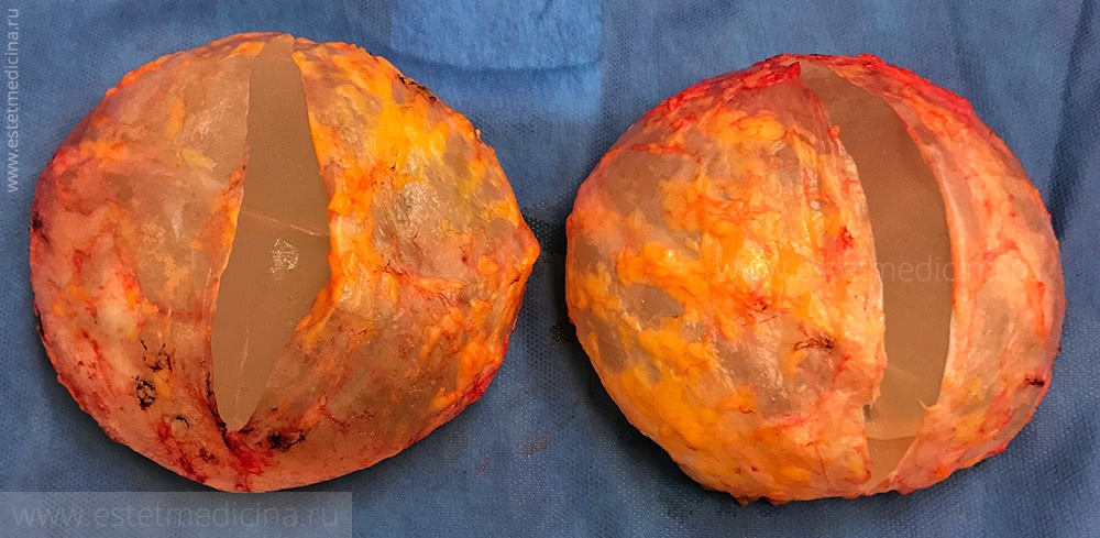 Удаление грудных имплантов для восстановления здоровья и естественной красоты