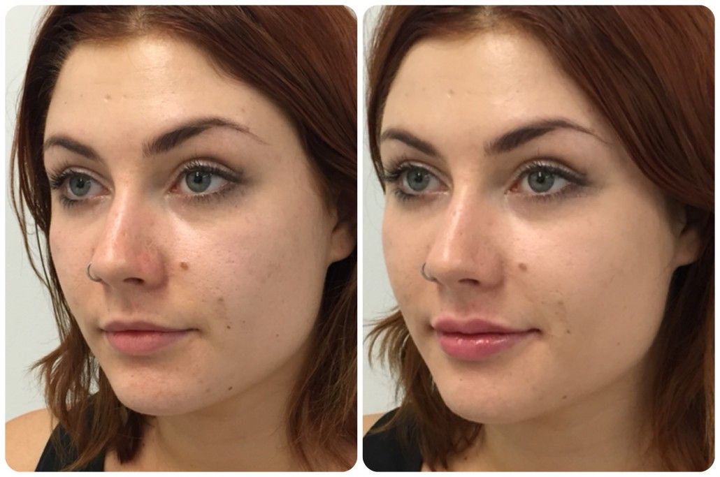 Пластика скул для создания гармоничного и выразительного контура лица