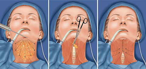 Липосакция подбородка: вернуть четкий овал лица и избавиться от второго подбородка