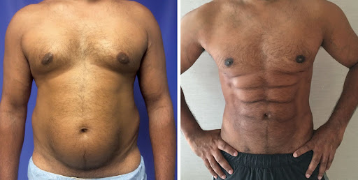 Гравировка пресса: создание атлетического рельефа живота с помощью пластики