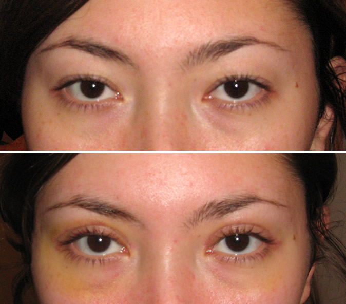 Эпикантопластика: как изменить форму глаз и получить открытый взгляд