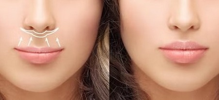 Пластика булхорн для гармонизации лица и создания привлекательной улыбки